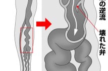 出産経験ある女性の2人に1人が発症　「下肢静脈瘤」の恐怖