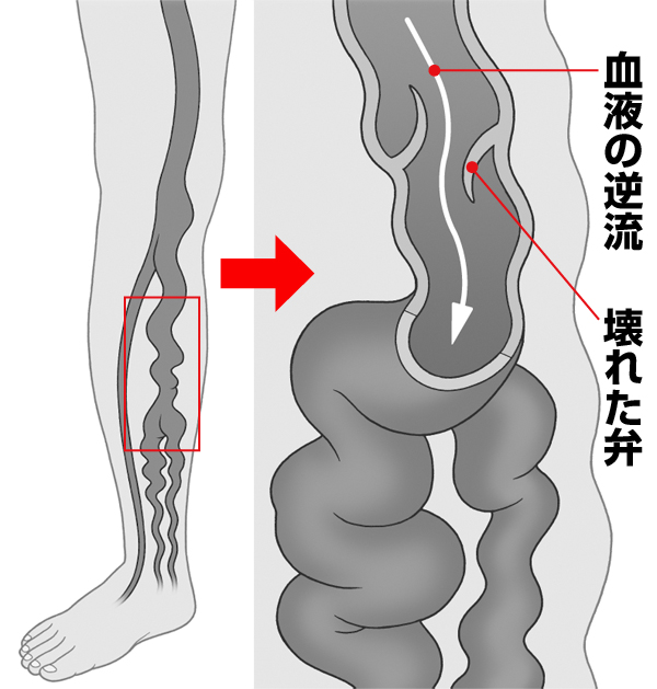 出産経験ある女性の2人に1人が発症 下肢静脈瘤 の恐怖 Newsポストセブン