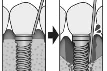 一生モノと思っていたインプラントに大問題、歯周病で脱落も