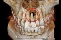 虫歯の感染で鼻の下の骨も溶ける、最新の根管治療でほぼ修復