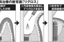 重度の歯周炎に新薬リグロス登場、手術で救える可能性も