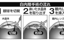 白内障手術の流れ