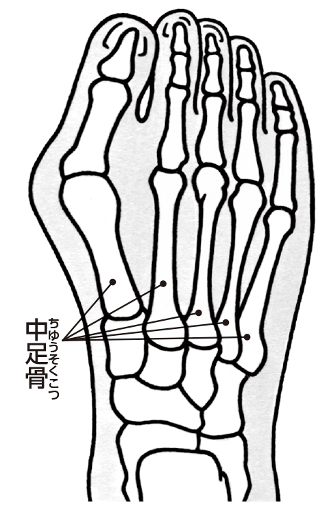 外反母趾の骨の状態