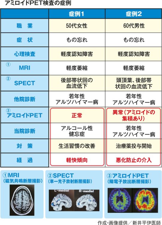 【1】MRI：強い磁場の中で人体に電波を当て、どんな方向からでも形態の画像を得ることができ、脳の萎縮や出血の程度が詳細にわかる
【2】SPECT：脳の血流から、ダメージを受けた部分を調べる。MRIよりも初期の病変を見つけられ、機能が低下している箇所がよくわかる
【3】アミロイドPET：脳の中にあるアミロイドβの沈着を調べ、発症前にアルツハイマー病を発見できる。左側が「正常」、右側が「異常」