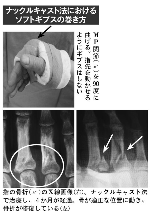 ナックルキャスト法におけるソフトギプスの巻き方