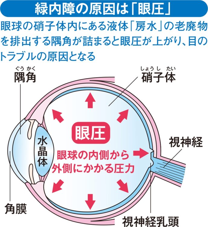 緑内障の原因は眼圧