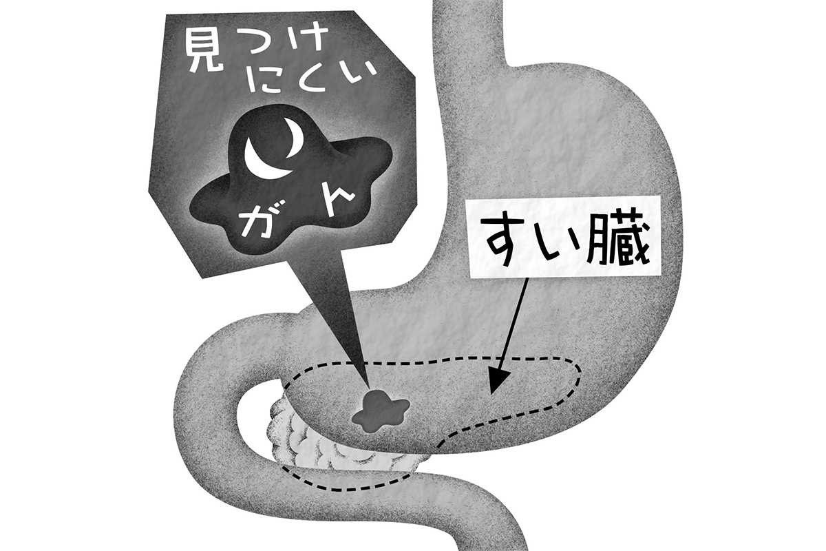 超音波内視鏡 ですい臓がんを早期発見 適切な治療に繋ぐ Newsポストセブン