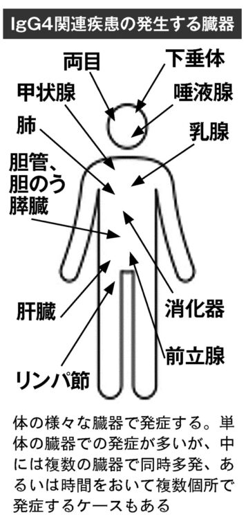 IgG4関連疾患の発生する臓器