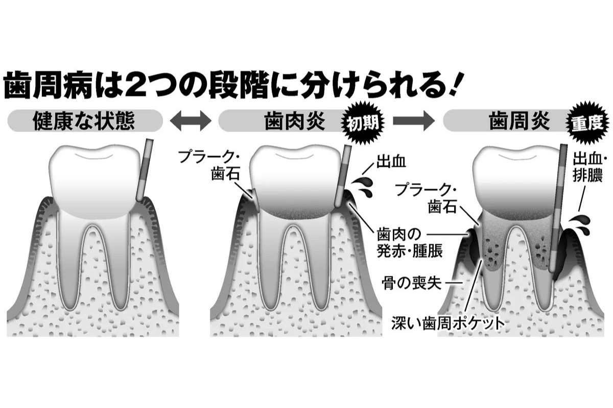 歯周病 歯肉炎 と 歯周炎 で治療法は異なる 重度の場合は外科手術も Newsポストセブン