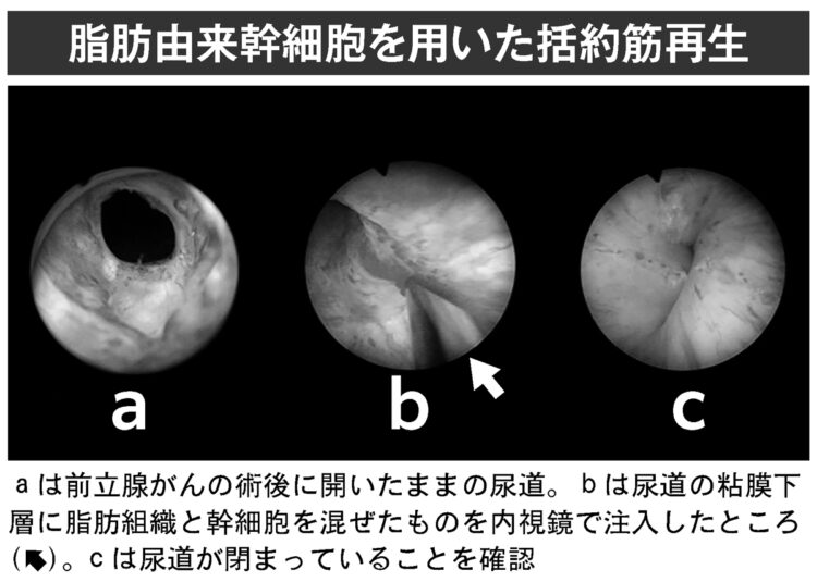 脂肪由来幹細胞を用いた括約筋再生