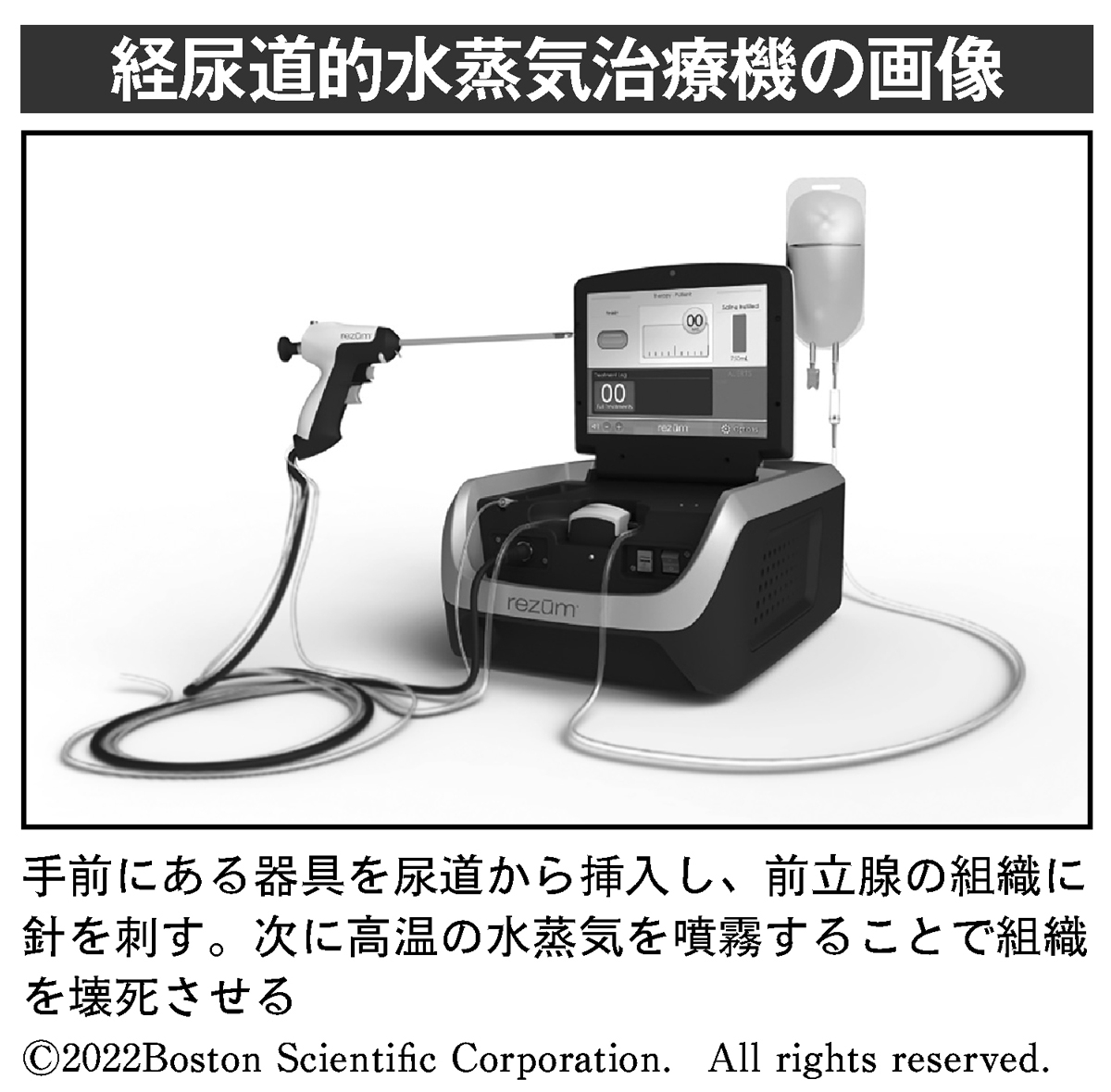 出血なく前立腺肥大を解消する高齢者に適した「水蒸気治療」｜newsポストセブン Part 2