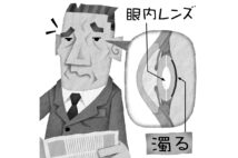 「後発白内障」はYAGレーザーで完治（イラスト／いかわやすとし）