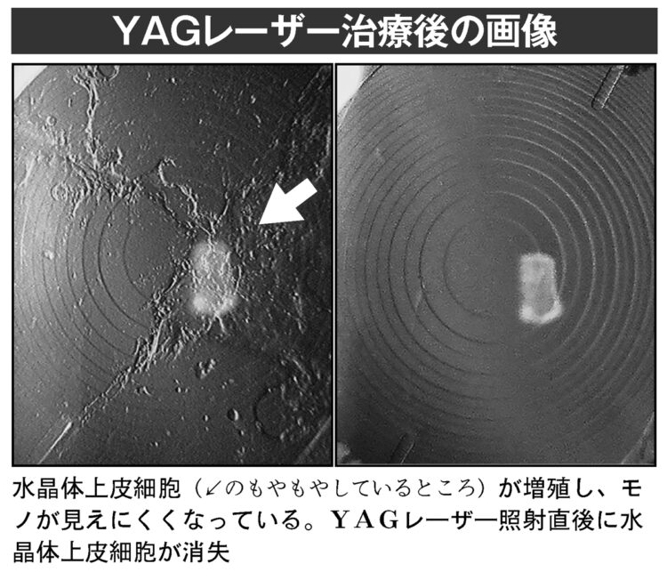 YAGレーザー治療後の画像