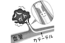 「血管内治療」はどういった治療法？（イラスト／いかわやすとし）