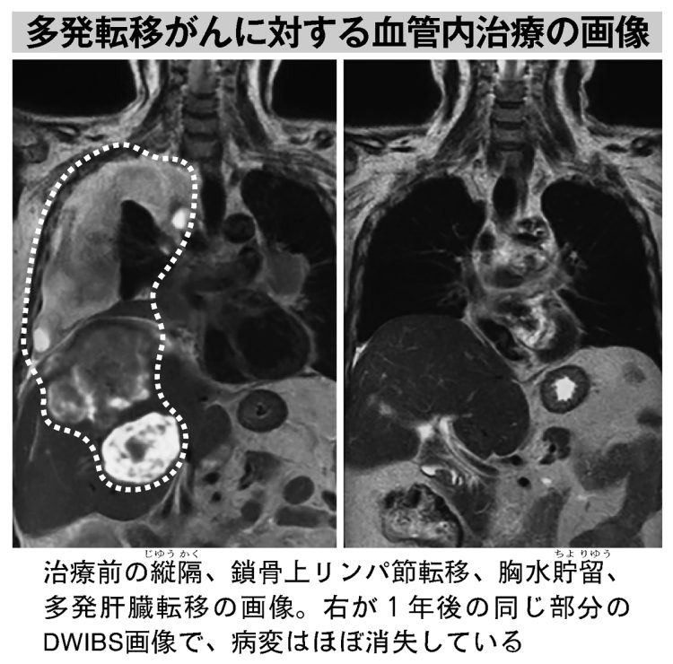 多発転移がんに対する血管内治療の画像