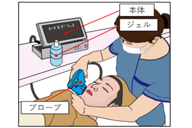 ハイフ施術のイメージ。出典／消費者庁 消費者安全調査委員会