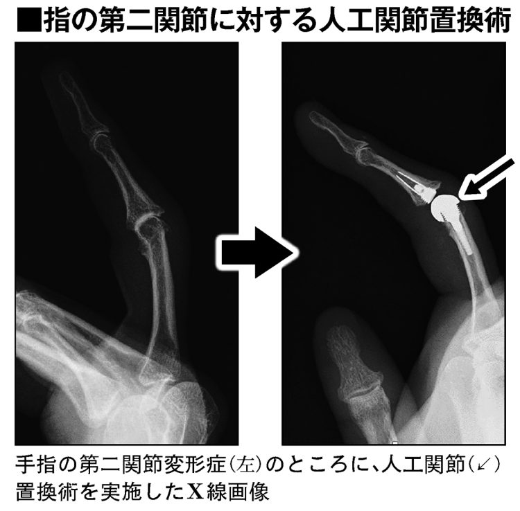 指の第二関節に対する人工関節置換術