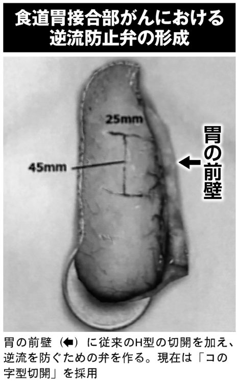 食道胃接合部がんにおける逆流防止弁の形成