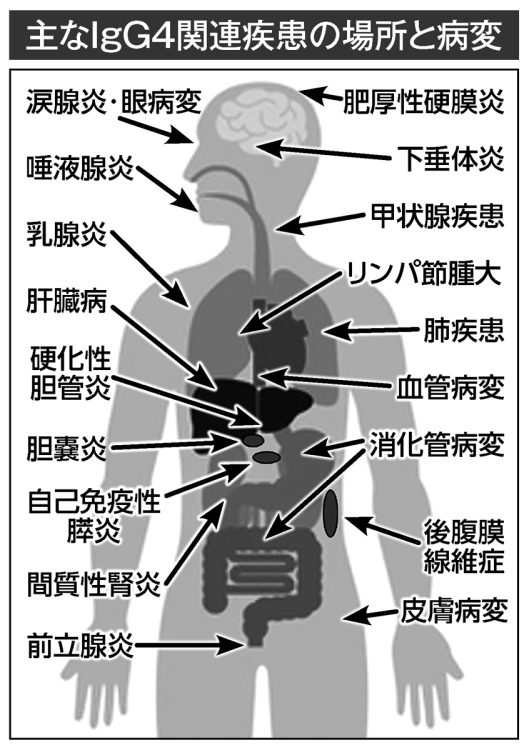 主なIgG4関連疾患の場所と病変