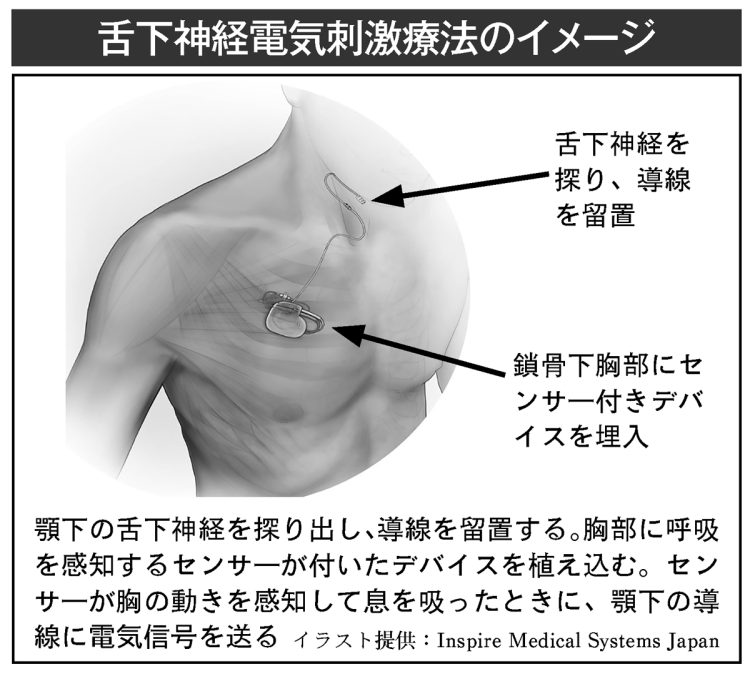 舌下神経電気刺激療法のイメージ