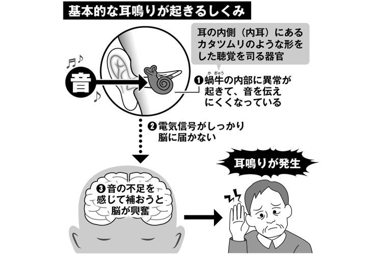 基本的な耳鳴りが起きるしくみ