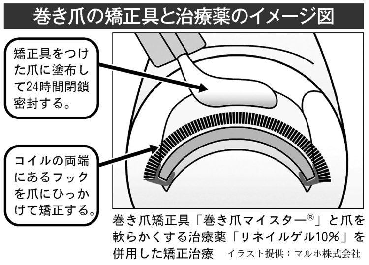 巻き爪の矯正具と治療薬のイメージ図