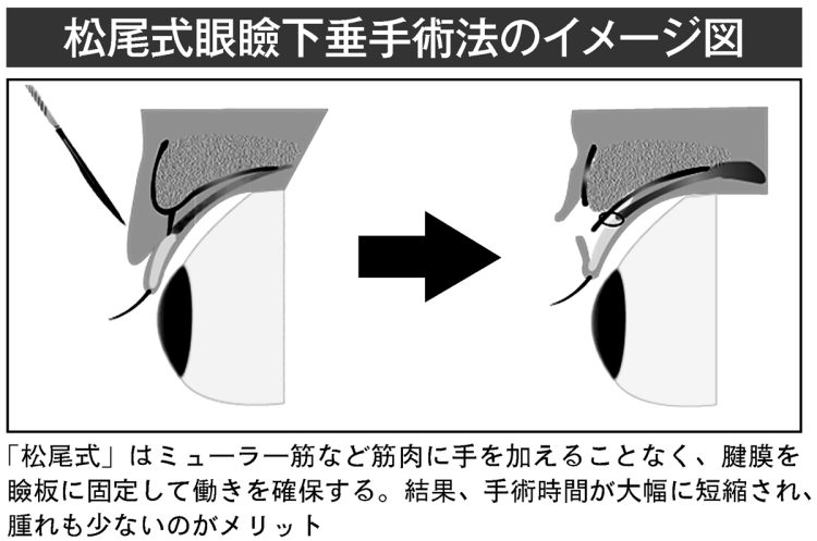 松尾式眼瞼下垂手術法のイメージ図