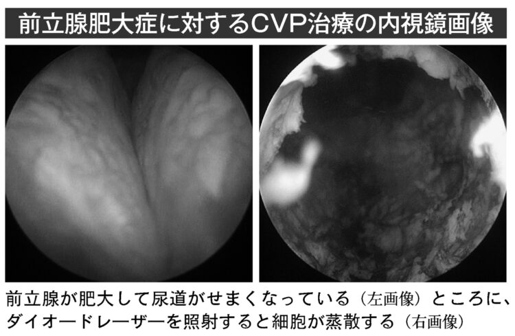 前立腺肥大に対するCVP治療の内視鏡画像