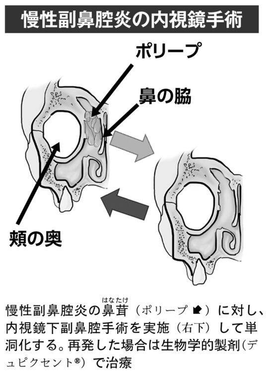 慢性副鼻腔炎の内視鏡手術