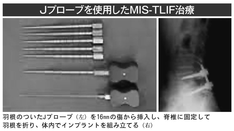 Jプローブを使用したMIS-TLIF治療