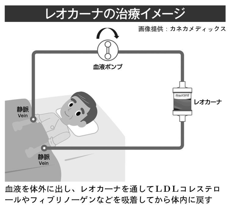 レオカーナの治療イメージ