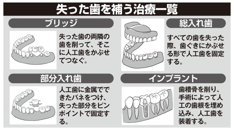 失った歯を補う治療一覧