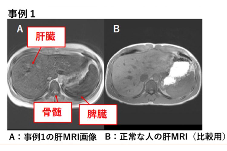 医師から国民生活センターに提供された10代女性の鉄過剰症の画像診断。肝臓、脾臓、骨髄が低信号（黒く映る）で、鉄沈着が疑われた（国民生活センターの公式サイトより）