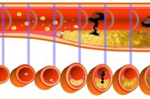 【慢性炎症と動脈硬化の関係】心筋梗塞につながる動脈硬化は幼少期から始まっている　生活習慣病が動脈硬化を進行させるメカニズム【専門医が解説】